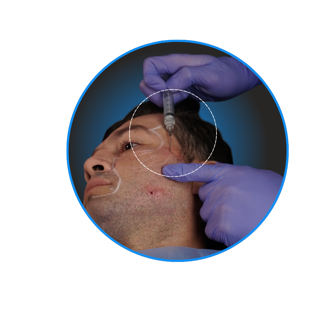 Aplicación facial de Sculptra · Demostración de técnica